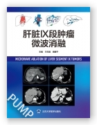 肝脏IX段肿瘤微波消融